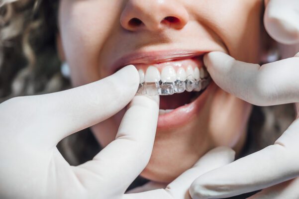 Telsiz Ortodonti (invisalign)
